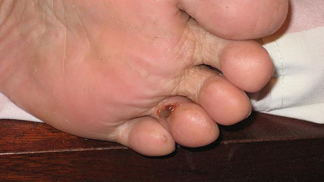 07-24-08 001 Carmen removing a bug from her foot