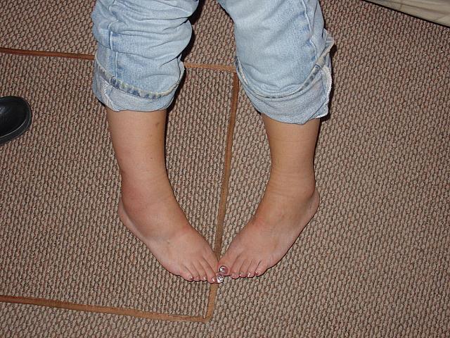 DSC01419 swollen ankels